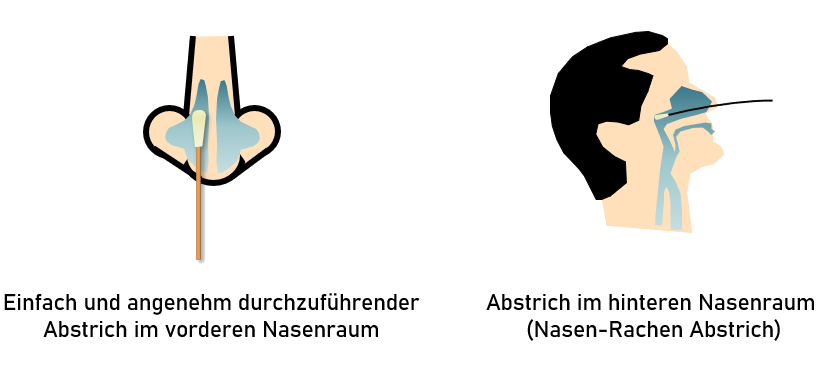 Anteriornasale vs rinofaringe
